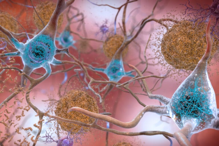 MIT Alzheimers Gene 01 press